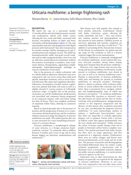 Urticaria Multiforme: a Benign Frightening Rash Mariana Barros ‍ ‍ , Joana Antunes, Sofia Moura Antunes, Rita Calado