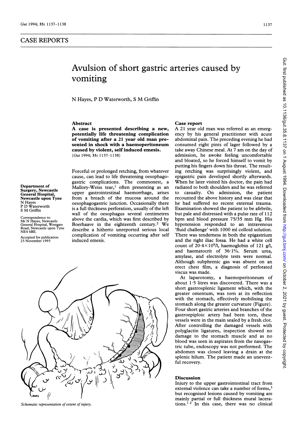 Avulsion of Short Gastric Arteries Caused by Vomiting