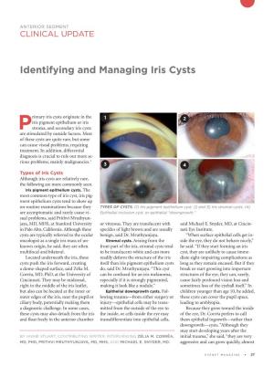 Identifying and Managing Iris Cysts