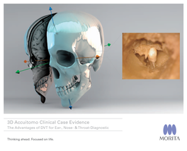 3D Accuitomo Clinical Case Evidence the Advantages of DVT for Ear-, Nose- & Throat-Diagnostic