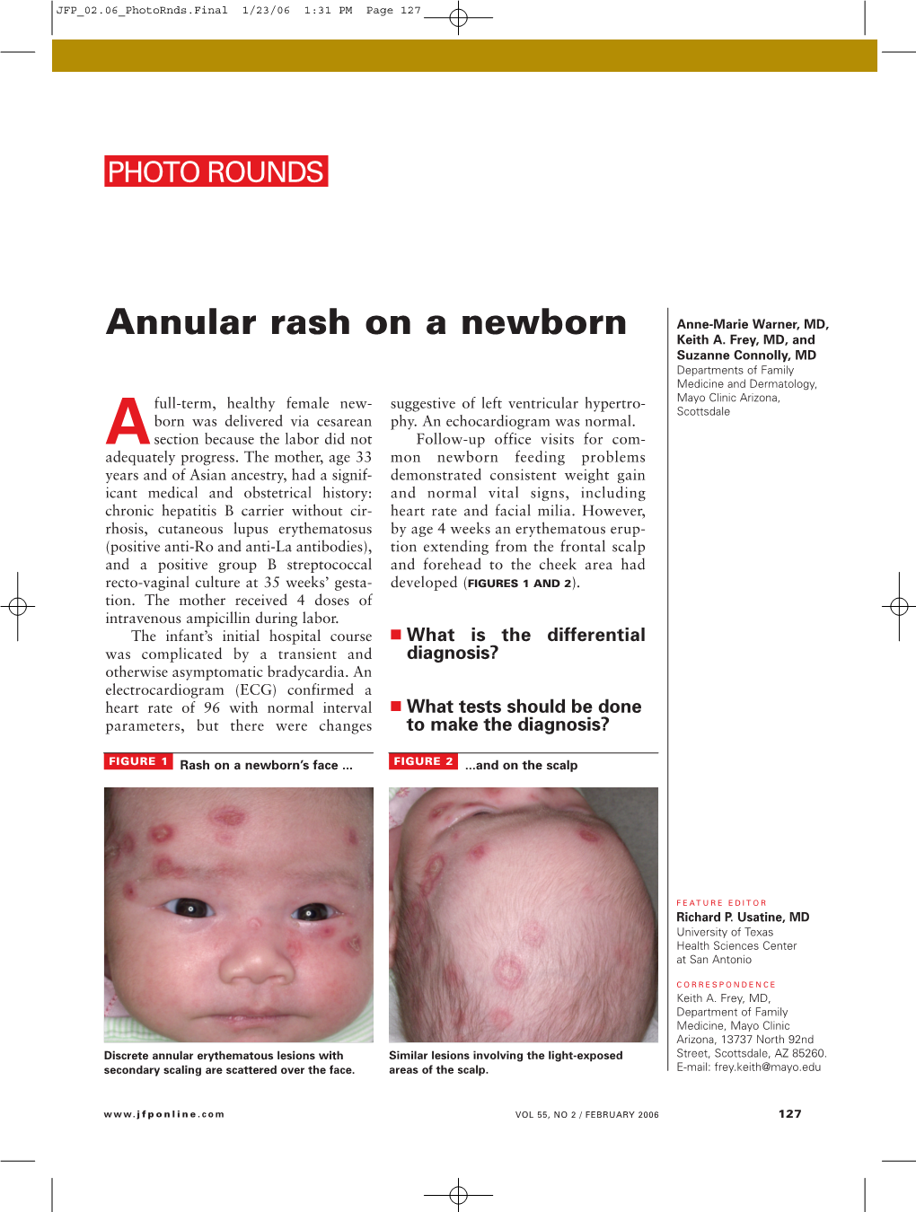 Annular Rash on a Newborn Keith A