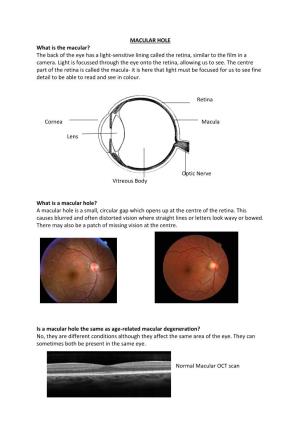 MACULAR HOLE What Is the Macular? the Back of the Eye Has a Light-Sensitive Lining Called the Retina, Similar to the Film in a Camera