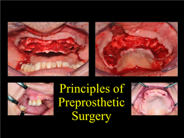 Preprosthetic Surgery