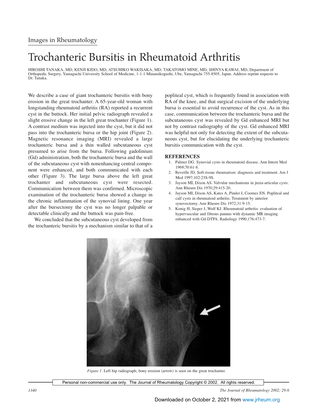 Trochanteric Bursitis in Rheumatoid Arthritis