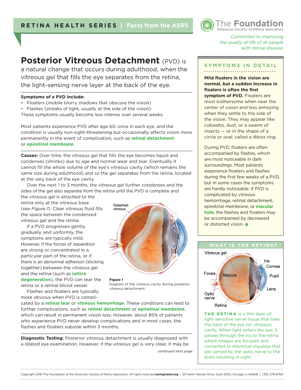 Posterior Vitreous Detachment (PVD) Is