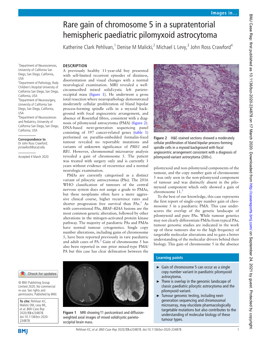 Rare Gain of Chromosome 5 in a Supratentorial Hemispheric