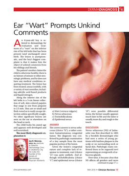 Ear “Wart” Prompts Unkind Comments