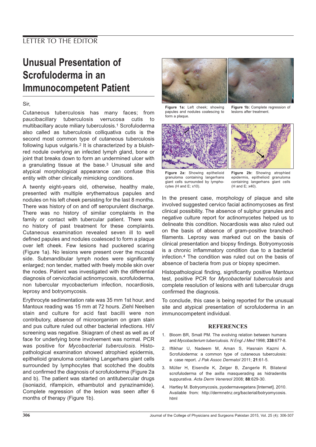 Unusual Presentation of Scrofuloderma in an Immunocompetent Patient