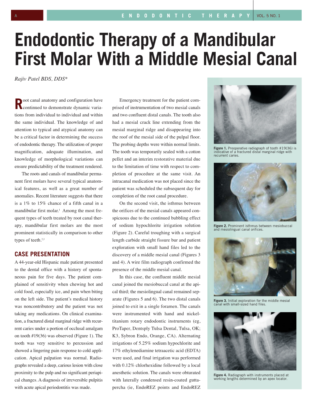 Middle Mesial Canal in a Mandibular Molar