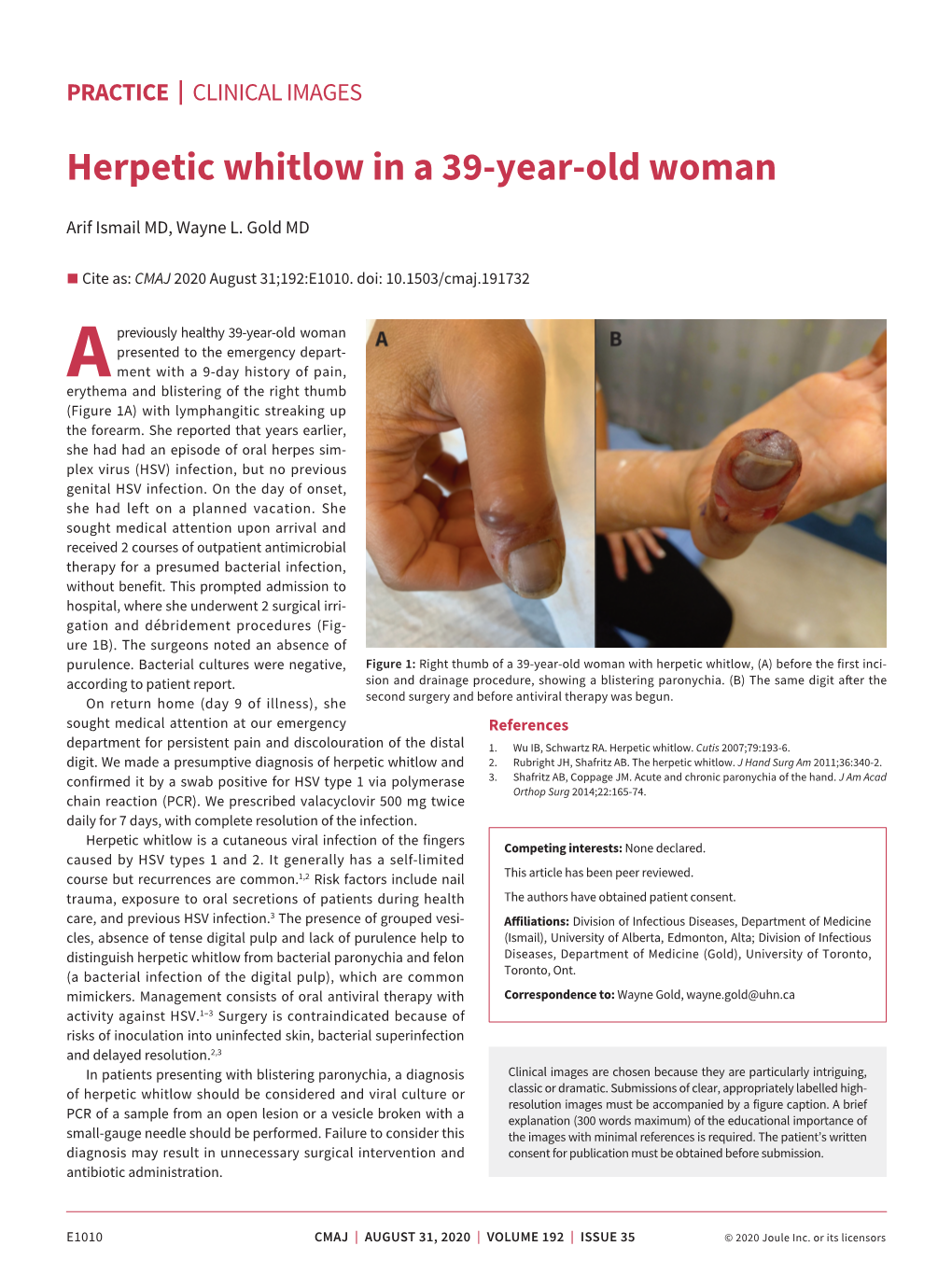 Herpetic Whitlow in a 39-Year-Old Woman