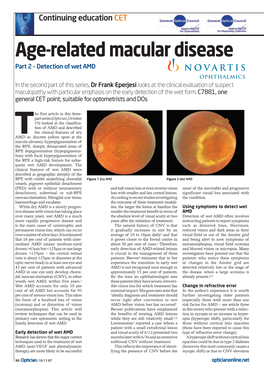 Age-Related Macular Disease Part 2 – Detection of Wet AMD