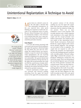 Clinical SHOWCASE Unintentional Replantation: a Technique to Avoid