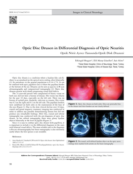 Optic Disc Drusen in Differential Diagnosis of Optic Neuritis Optik Nörit Ayrıcı Tanısında Optik Disk Druzeni