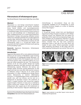 CASE REPORT Fibromatosis of Infratemporal Space Riaz Ahmed Warraich, Tooba Saeed, Nabila Riaz, Asma Aftab