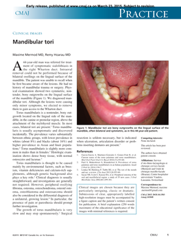 Mandibular Tori