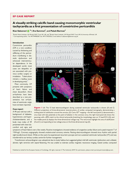 Constrictive Pericarditis Causing Ventricular Tachycardia.Pdf