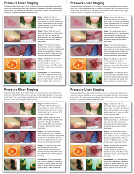 Pressure Ulcer Staging Cards and Skin Inspection Opportunities.Indd