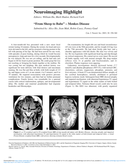 Menkes Disease Submitted By: Alice Ho, Jean Mah, Robin Casey, Penney Gaul