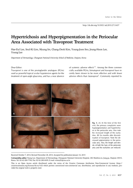 Hypertrichosis and Hyperpigmentation in the Periocular Area Associated with Travoprost Treatment