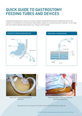 Quick Guide to Gastrostomy Feeding Tubes and Devices