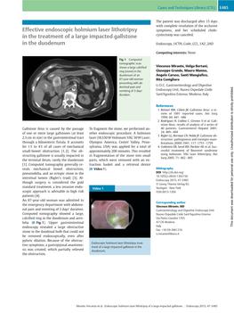 Effective Endoscopic Holmium Laser Lithotripsy in the Treatment of a Large