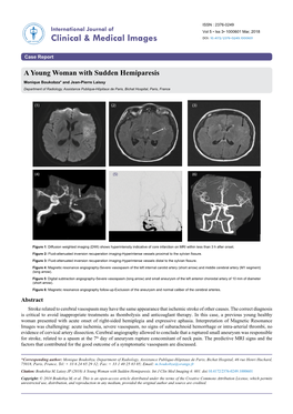 A Young Woman with Sudden Hemiparesis