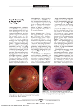 Torpedo Maculopathy at the Site of the Fetal “Bulge”