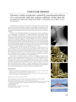 Thoracic Outlet Syndrome Caused by Pseudoarticulation of a Cervical Rib with the Scalene Tubercle of the First