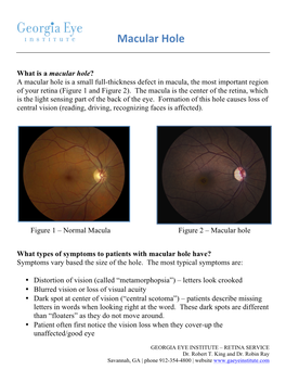 Macular Hole