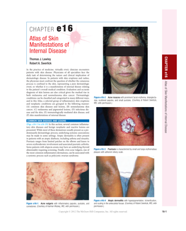 CHAPTER E16 Atlas of Skin Manifestations of Internal Disease CHAPTER E16 Thomas J