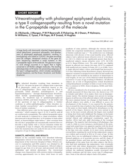 Vitreoretinopathy with Phalangeal Epiphyseal Dysplasia, a Type II