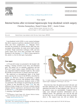 Internal Hernia After Revisional Laparoscopic Loop Duodenal Switch