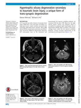 Hypertrophic Olivary Degeneration Secondary to Traumatic Brain Injury: a Unique Form of Trans-Synaptic Degeneration Raman Mehrzad,1 Michael G Ho2