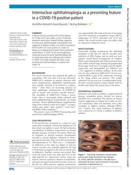 Internuclear Ophthalmoplegia As a Presenting Feature in a COVID-19-­Positive Patient Varshitha Hemanth Vasanthpuram,1 Akshay Badakere ‍ ‍ 2