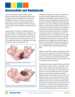 Gastroschisis and Omphalocele