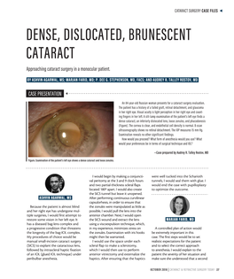 DENSE, DISLOCATED, BRUNESCENT CATARACT Approaching Cataract Surgery in a Monocular Patient