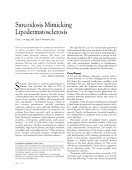 Sarcoidosis Mimicking Lipodermatosclerosis