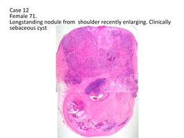 Case 12 Female 71. Longstanding Nodule from Shoulder Recently Enlarging