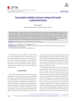 Sarcomatoid Urothelial Carcinoma Arising in the Female Urethral Diverticulum