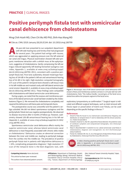 Positive Perilymph Fistula Test with Semicircular Canal Dehiscence from Cholesteatoma