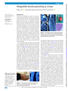 Infrapatellar Bursitis Presenting As a Lump Mantu Jain ‍ ‍ , Manmatha Nayak, Sajid Ansari, Bishnu Prasad Patro ‍ ‍