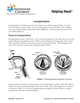 Laryngomalacia