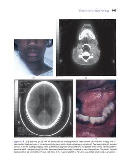 Pediatric Salivary Gland Pathology Figure 15.9. an 8-Year-Old Girl (A