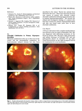 Sir, Metastatic Calcification in the Eye Is Often Seen in the Cornea and the Interpalpebral Conjunctiva. in Hypercalcaemic Subje