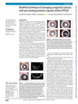 Existing Posterior Capsular Defect (PPCD)