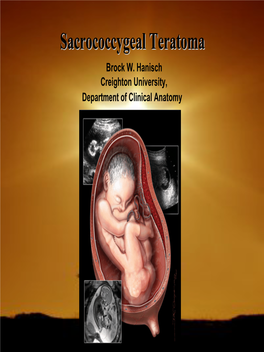 Sacrococcygeal Teratomateratoma Brock W