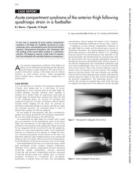 Acute Compartment Syndrome of the Anterior Thigh Following Quadriceps Strain in a Footballer B J Burns, J Sproule, H Smyth