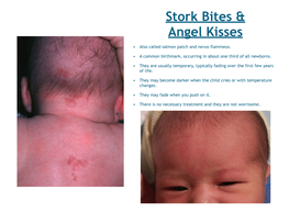 Stork Bites & Angel Kisses