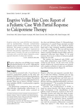 Eruptive Vellus Hair Cysts: Report of a Pediatric Case with Partial Response to Calcipotriene Therapy