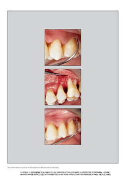 The International Journal of Periodontics & Restorative Dentistry © 2019 by QUINTESSENCE PUBLISHING CO, INC. PRINTING of TH